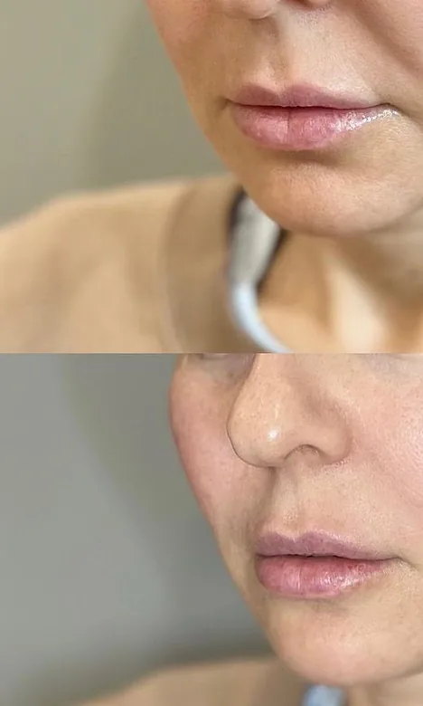 Bas du visage et cou d'une patiente avant la séance d'Endolift du double menton chez My Laser Maroc