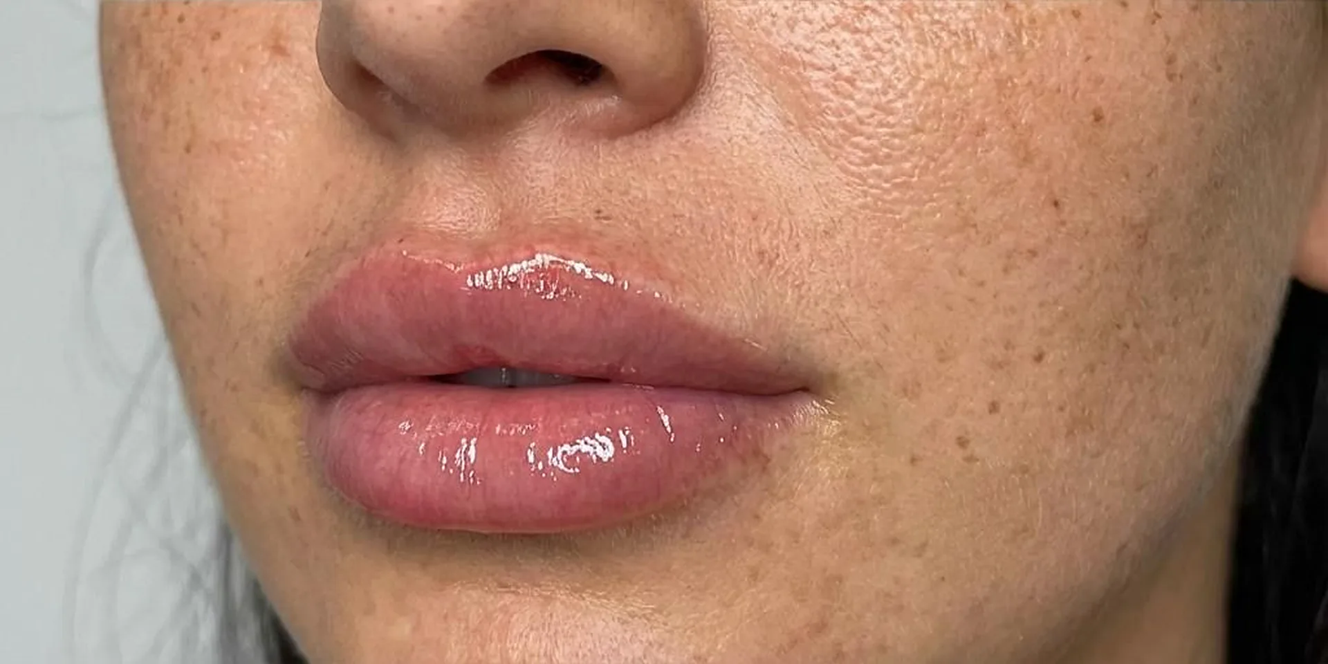 Bas du visage d'une patiente après une injection d'acide hyaluronique des lèvres chez My Laser Casablanca, lèvres pleines au rendu naturel