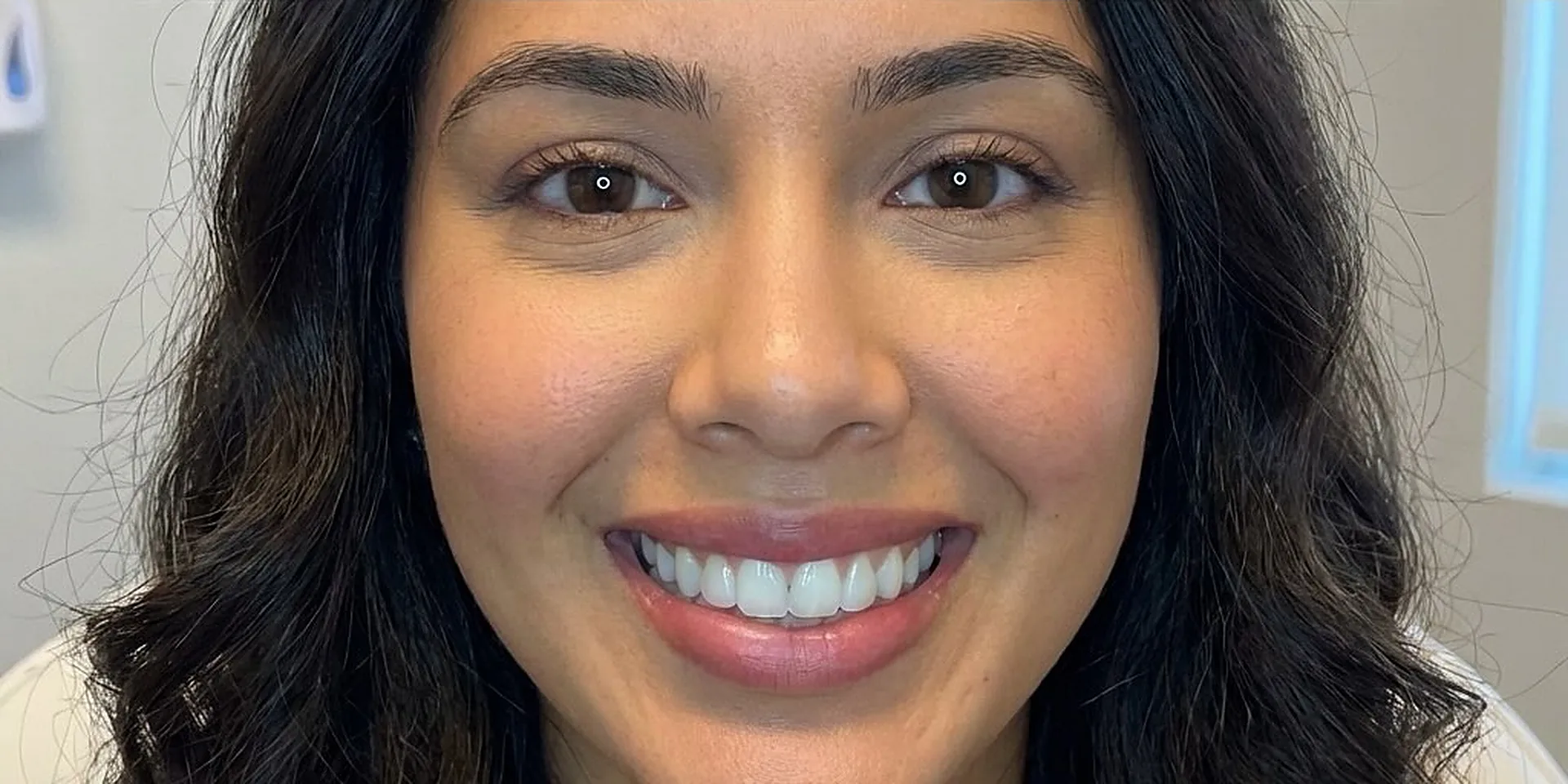 Sourire d'une patiente après une injection de toxine botulique chez My Laser
