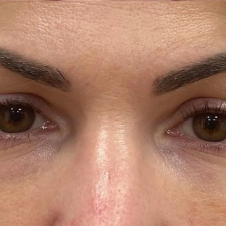Regard d'une patiente après une injection d'acide hyaluronique des cernes chez My Laser Maroc