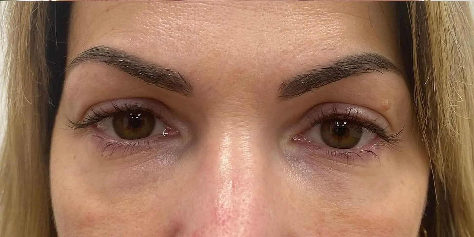Regard d'une patiente après une injection d'acide hyaluronique des cernes chez My Laser Maroc, creux sous les yeux comblé