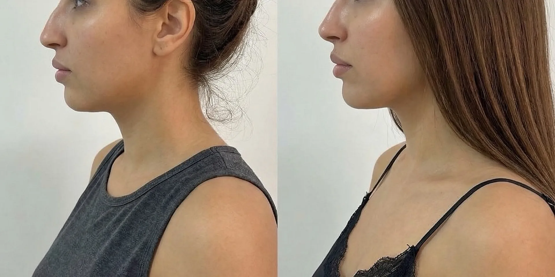Profil d'une patiente avant et après des injections d'acide hyaluronique du visage chez My Laser Maroc, ovale et mâchoire redessinés