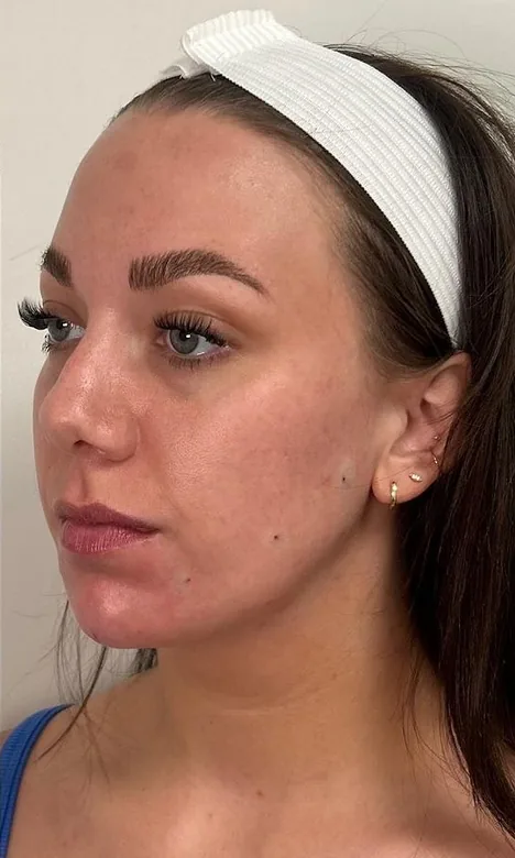 Ligne de la mâchoire redessinée après l'injection jawline d'acide hyaluronique chez My Laser Casablanca