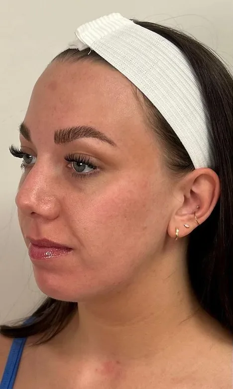 Visage de trois quarts d'une patiente avant l'injection jawline chez My Laser Casablanca