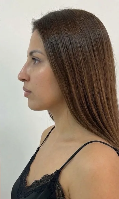 Profil d'une patiente après les injections d'acide hyaluronique du visage chez My Laser Maroc, menton et mâchoire redessinés