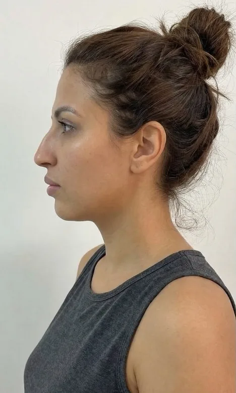 Profil d'une patiente avant les injections d'acide hyaluronique du visage chez My Laser Maroc