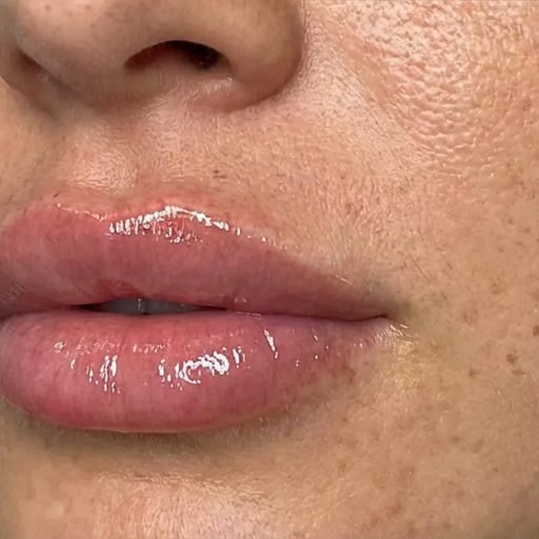 Lèvres repulpées au rendu naturel après l'injection d'acide hyaluronique chez My Laser Casablanca