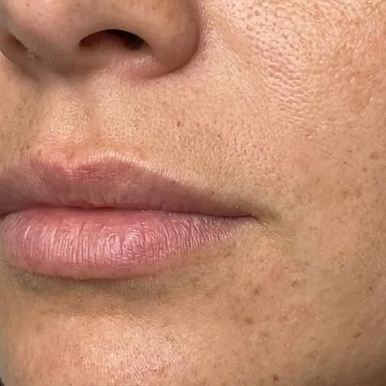 Lèvres fines d'une patiente avant l'injection d'acide hyaluronique chez My Laser Casablanca