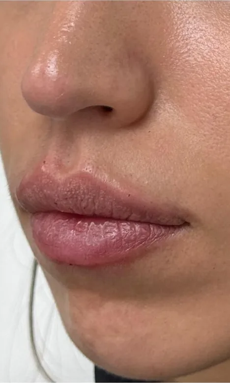 Lèvres hydratées et dessinées après l'injection d'acide hyaluronique chez My Laser Casablanca