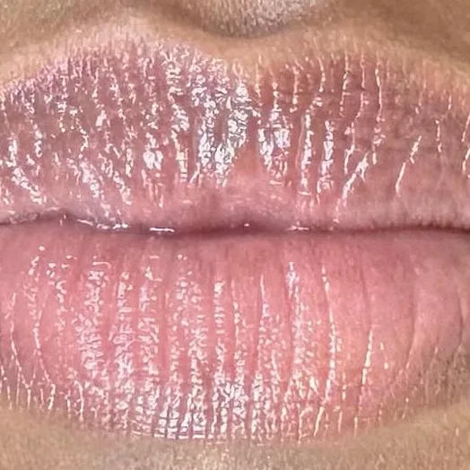 Lèvres éclaircies à la teinte rosée uniforme après le lips bleaching chez My Laser Casablanca