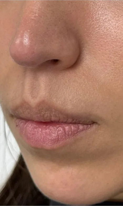 Lèvres d'une patiente avant l'injection d'acide hyaluronique chez My Laser Casablanca