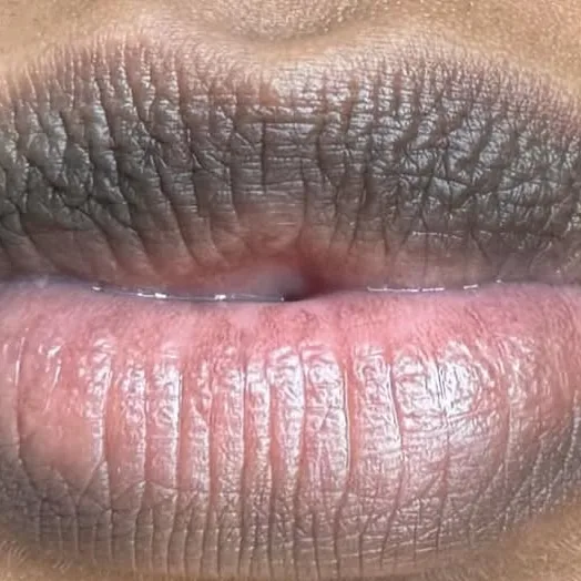 Lèvres foncées et hyperpigmentées avant le lips bleaching au laser chez My Laser Casablanca