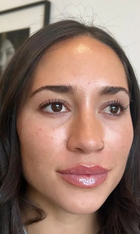 Visage d'une patiente après l'injection des lèvres à l'acide hyaluronique chez My Laser Casablanca, bouche plus pleine
