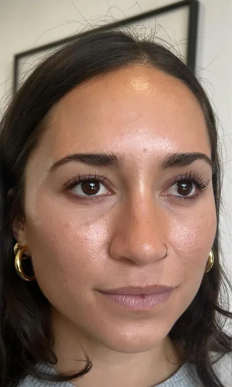 Visage d'une patiente avant l'injection des lèvres à l'acide hyaluronique chez My Laser Casablanca