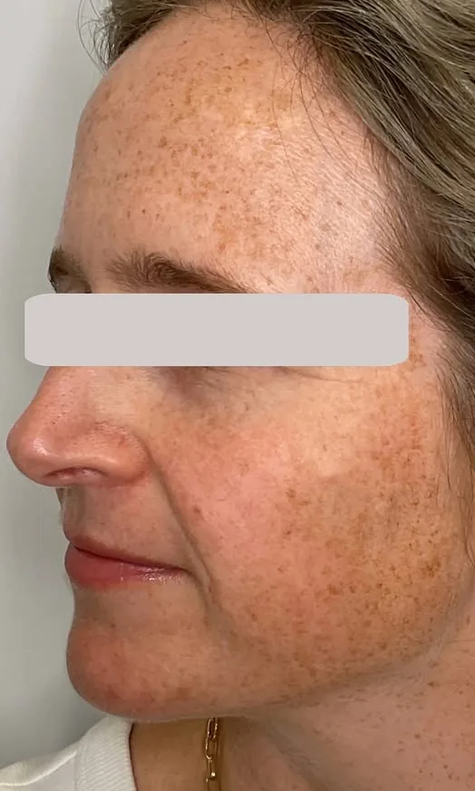 Visage d'une femme avec de nombreuses taches brunes avant le traitement dépigmentant chez My Laser Casablanca