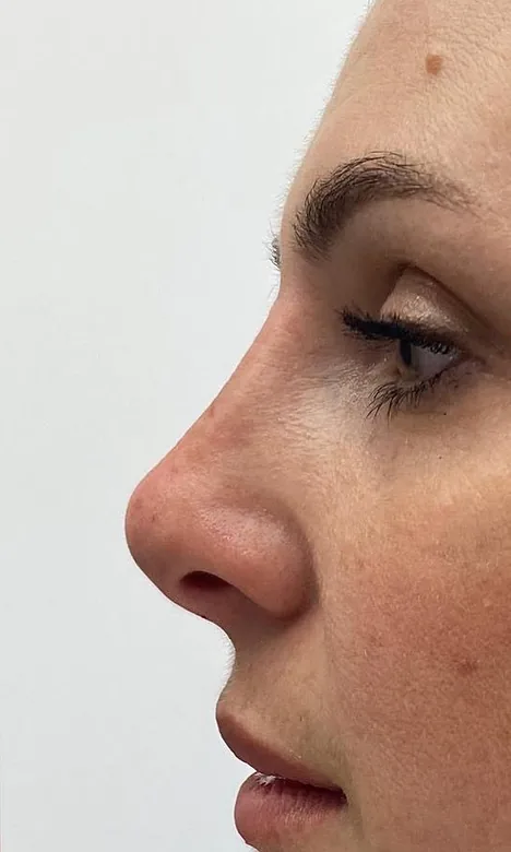 Arête du nez lissée de profil après la rhinoplastie médicale chez My Laser Casablanca