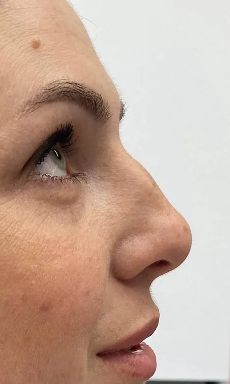 Bosse nasale visible de profil avant la rhinoplastie médicale chez My Laser Casablanca