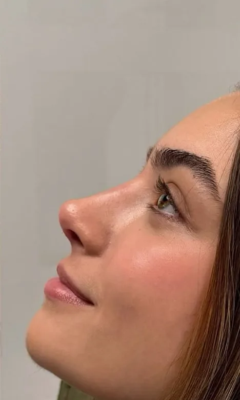 Profil du nez redessiné après la rhinoplastie médicale à l'acide hyaluronique chez My Laser Casablanca