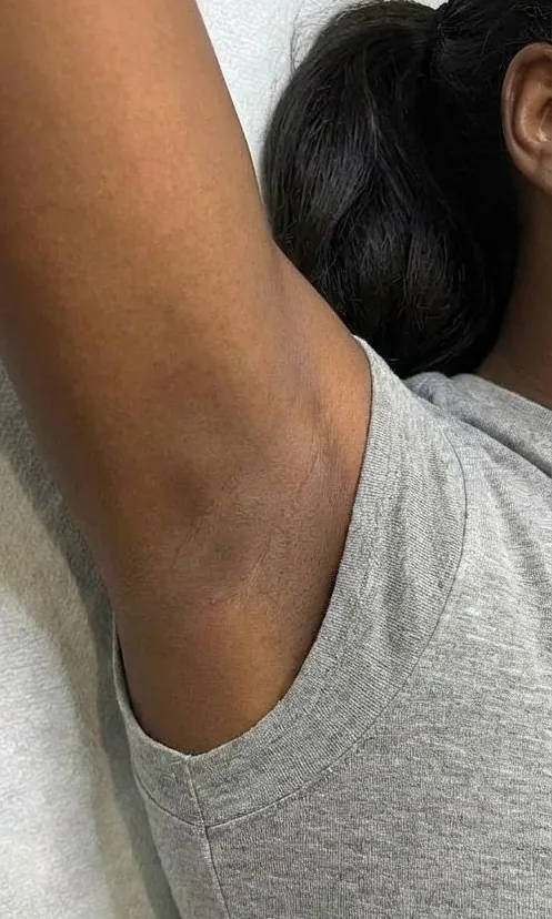 Aisselle éclaircie et unifiée après le peeling intime chez My Laser Casablanca
