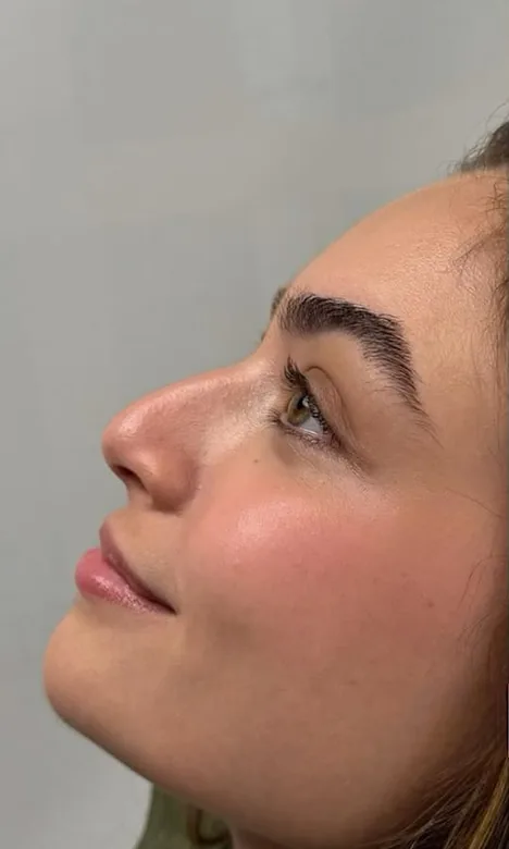 Profil du nez d'une patiente avant la rhinoplastie médicale chez My Laser Casablanca