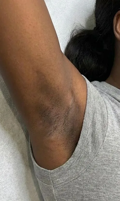 Aisselle foncée d'une femme à la peau brune avant le peeling intime chez My Laser Casablanca