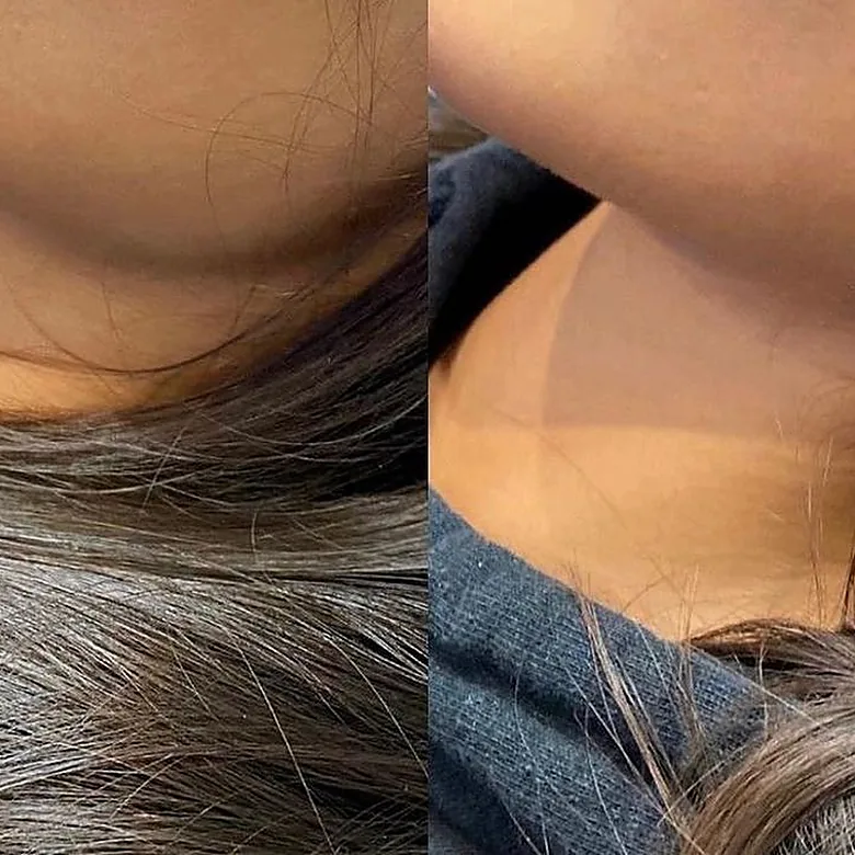 Profil du nez harmonisé après la rhinoplastie médicale chez My Laser Maroc