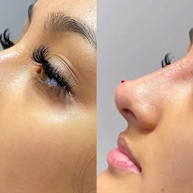 Profil du nez d'une patiente avant la rhinoplastie médicale chez My Laser Maroc