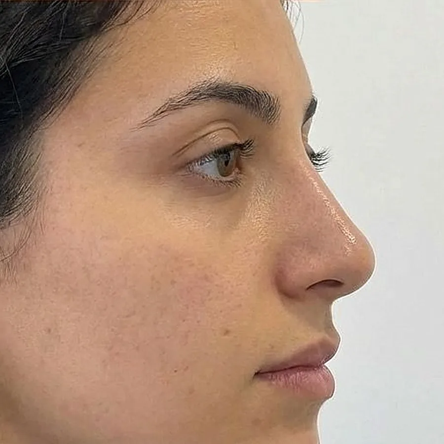 Profil d'une patiente après une rhinoplastie médicale à l'acide hyaluronique chez My Laser Maroc
