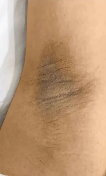 Aisselle avec une tache brune étendue avant le peeling intime chez My Laser Casablanca
