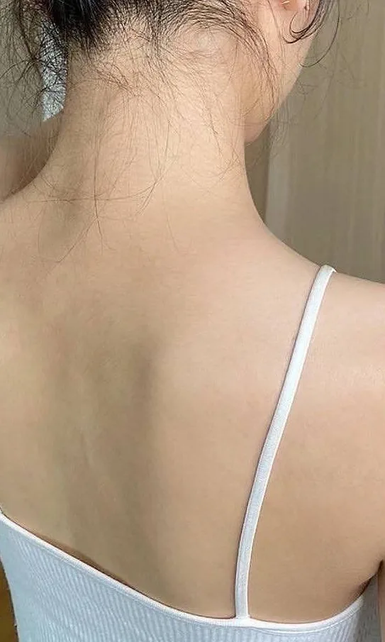 Haut du dos à la peau nette après le peeling TCA chez My Laser Casablanca