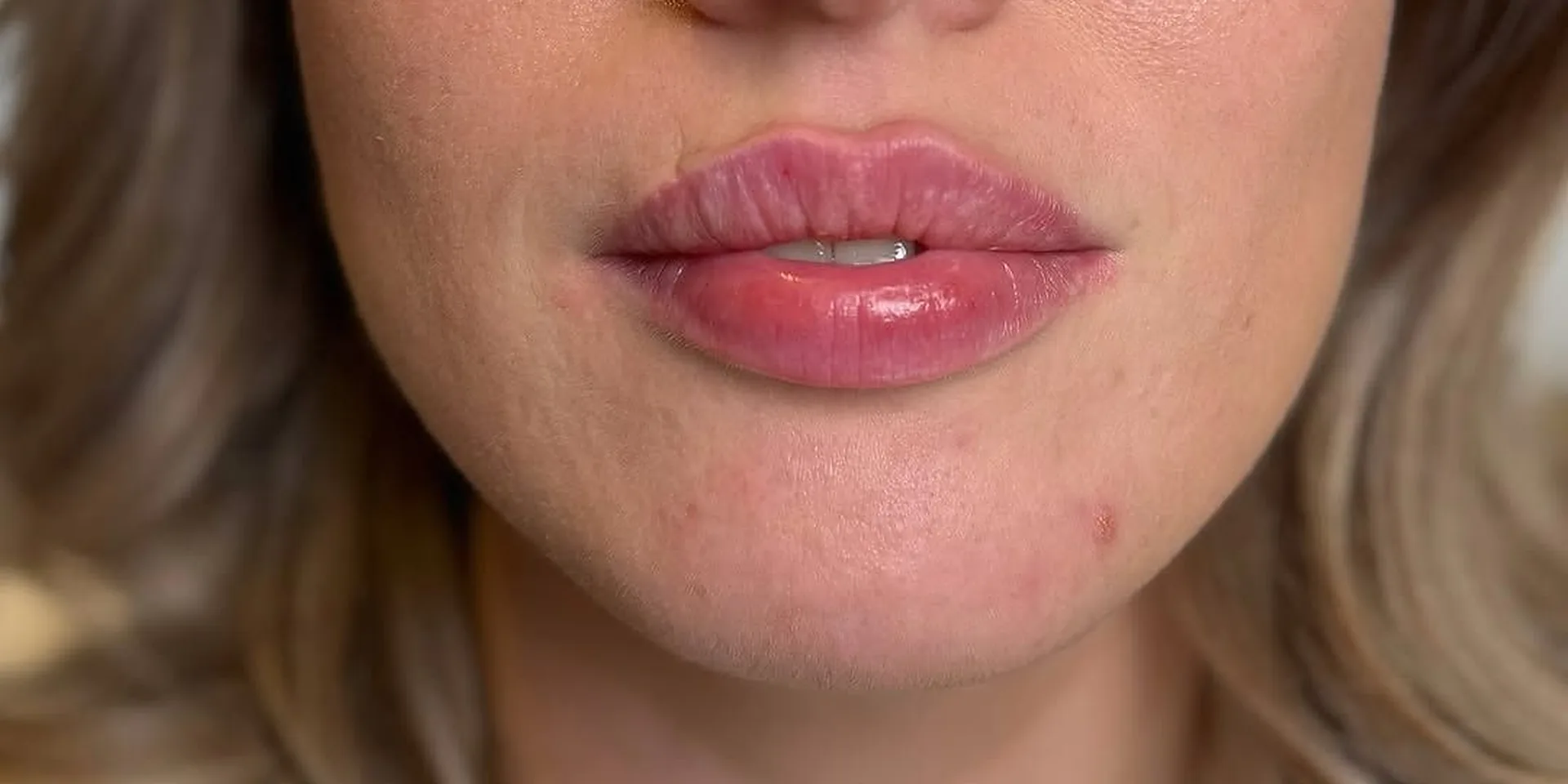 Lèvres repulpées et dessinées après une injection d'acide hyaluronique chez My Laser Casablanca, gros plan sur la bouche