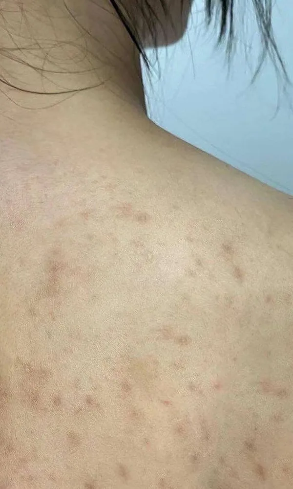 Haut du dos avec des marques d'acné avant le peeling TCA chez My Laser Casablanca