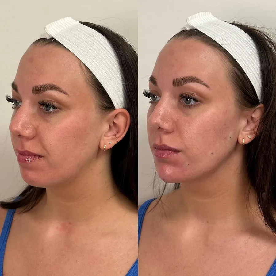 Visage de trois quarts d'une patiente après une injection jawline d'acide hyaluronique chez My Laser Maroc