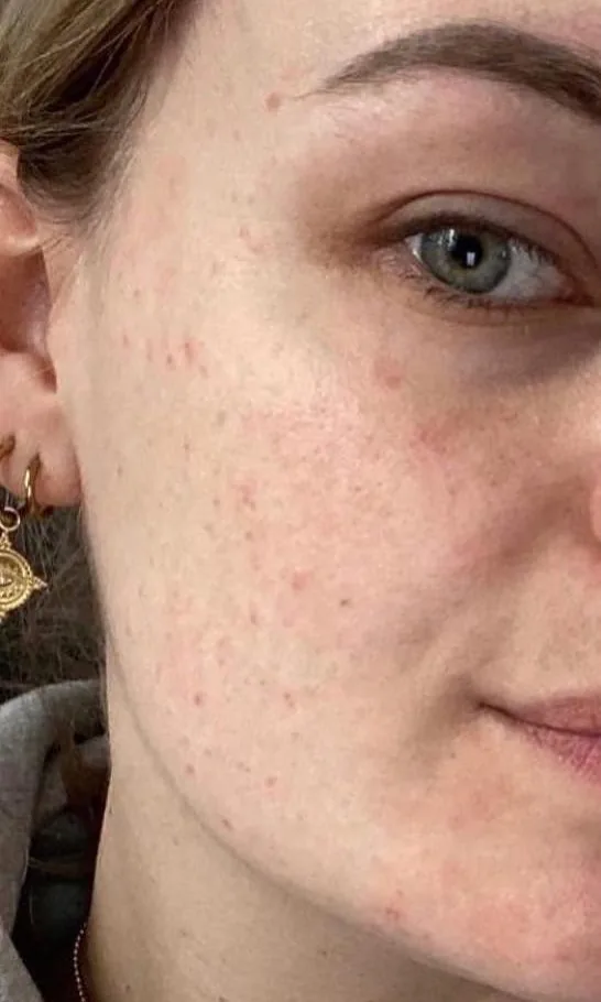 Joue d'une femme avec des taches et des imperfections avant le peeling TCA chez My Laser Casablanca