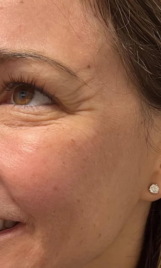 Contour de l'œil et joue lissés après le peeling TCA chez My Laser Casablanca