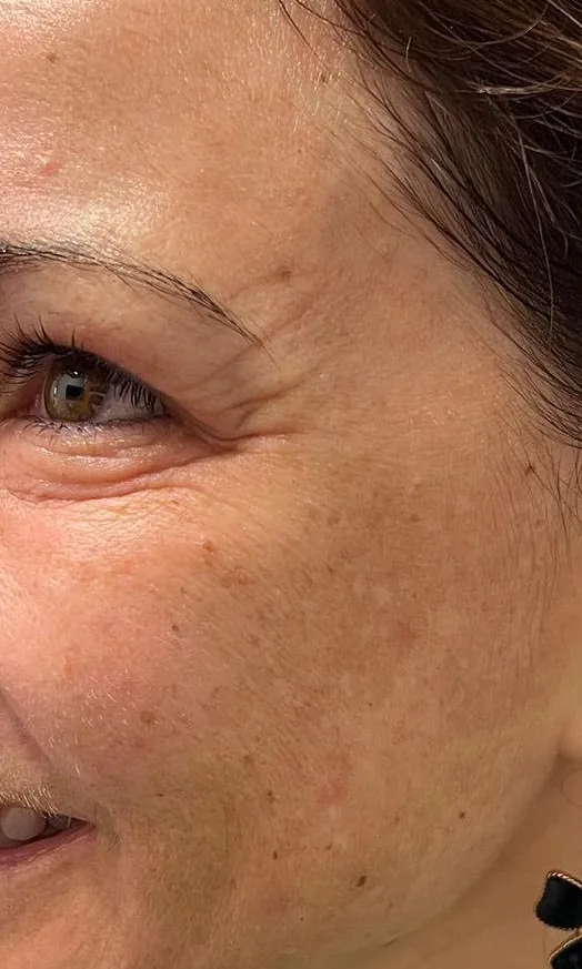 Contour de l'œil et joue marqués par des ridules et un teint irrégulier avant le peeling TCA chez My Laser Casablanca