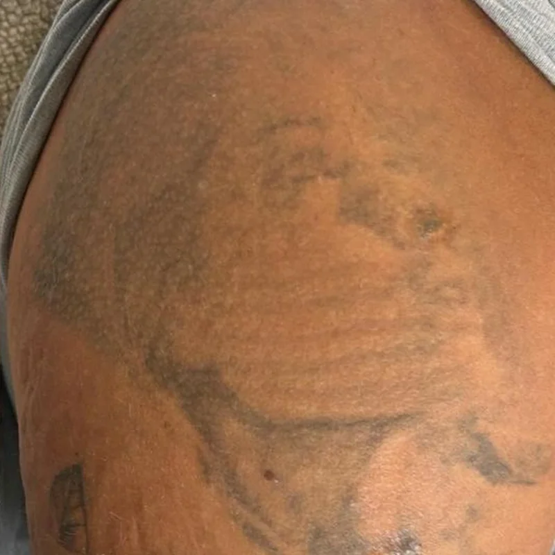 Même bras après plusieurs séances de détatouage laser, tatouage nettement éclairci, chez My Laser Tanger