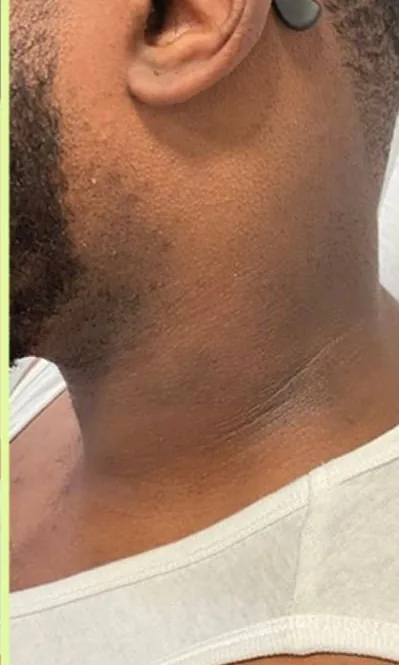 Nuque du même homme, peau nette et tatouage effacé, après les séances de détatouage laser chez My Laser Casablanca