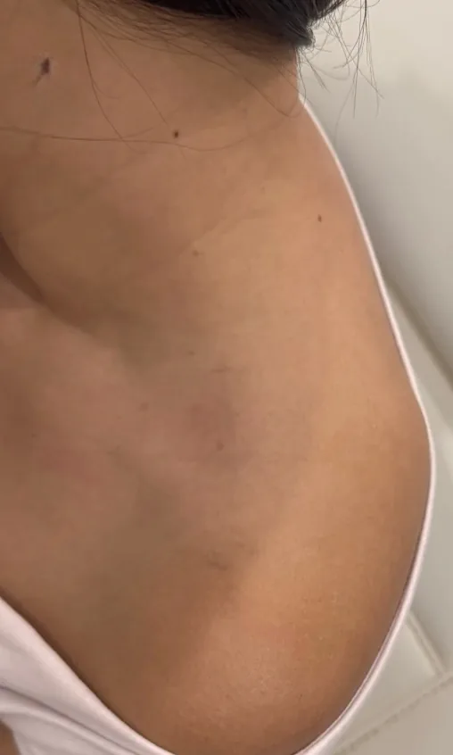 Décolleté de la même femme après les séances de détatouage laser, tatouage effacé, chez My Laser Casablanca