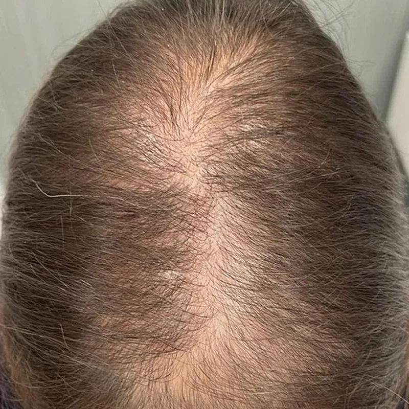 Vertex d'une femme aux cheveux châtains, zone clairsemée bien visible, avant le traitement capillaire chez My Laser Tanger